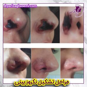 نکروز بینی - دکتر پریسا قاسمی
