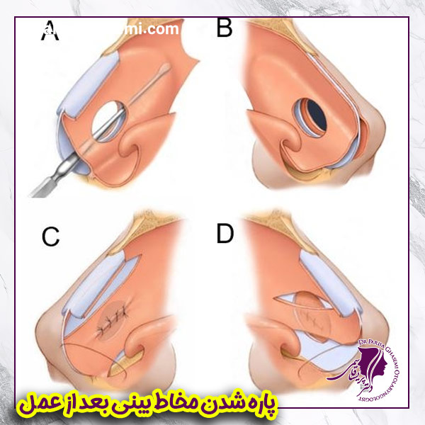 پارگی مخاط بینی بعد از عمل - دکتر پریسا قاسمی 