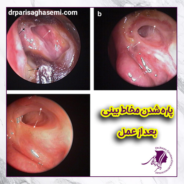 پارگی مخاط بینی بعد از عمل - دکتر پریسا قاسمی 
