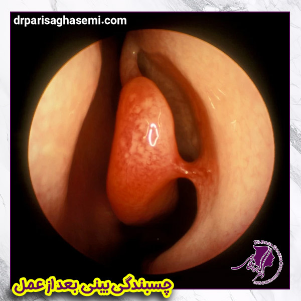 چسبندگی بینی بعد از عمل | دکتر قاسمی