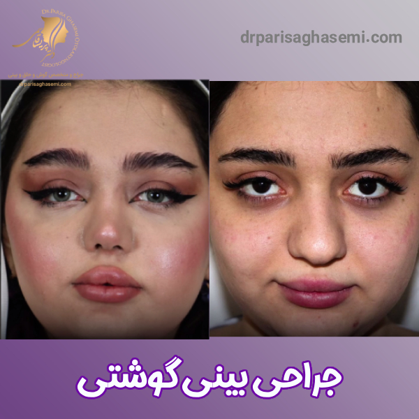 قبل و بعد عمل بینی گوشتی - دکتر قاسمی