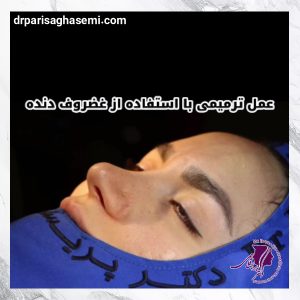 جراحی بینی ترمیمی - دکتر پریسا قاسمی