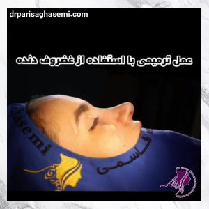 جراحی بینی ترمیمی - دکتر پریسا قاسمی