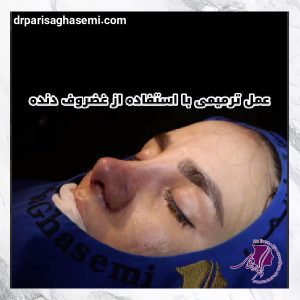 عمل بینی ترمیمی - دکتر پریسا قاسمی