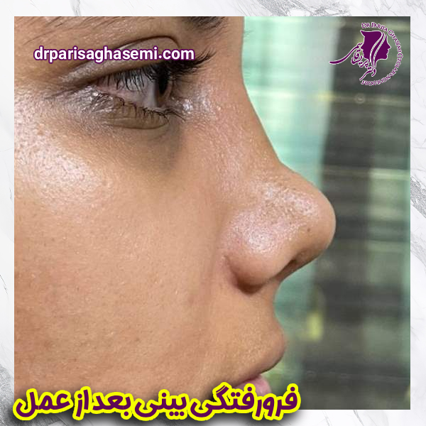 فرورفتگی بینی بعد از عمل - دکتر پریسا قاسمی