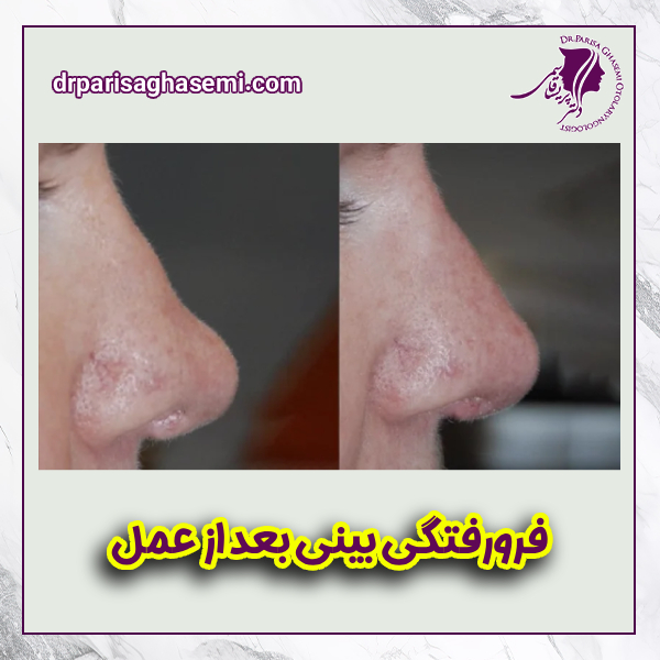 فرورفتگی بینی بعد از عمل - دکتر پریسا قاسمی 