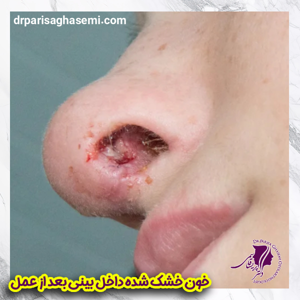 خون خشک داخل بینی بعد از عمل | دکتر پریسا قاسمی