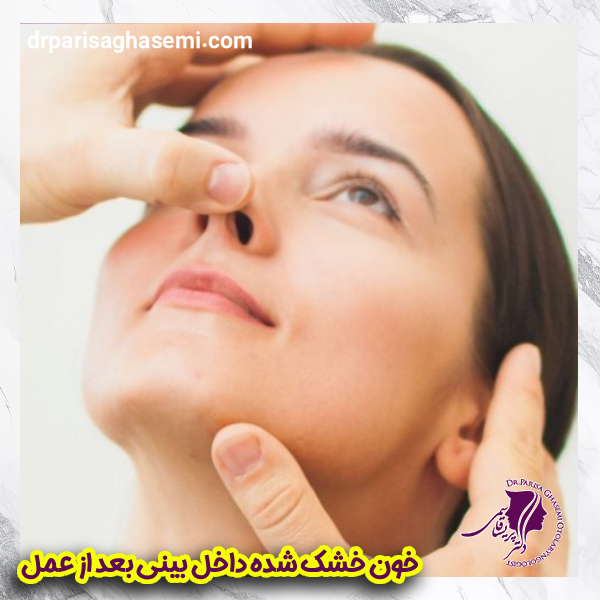 خون خشک داخل بینی بعد از عمل | دکتر پریسا قاسمی