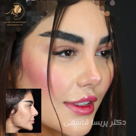 عکس قبل و بعد از عمل بینی - بهترین جراح بینی تهران