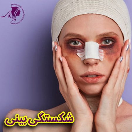 شکستگی-بینی شکستگی بینی + دکتر پریسا قاسمی